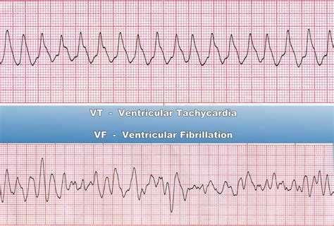Ventricular Tachycardia .